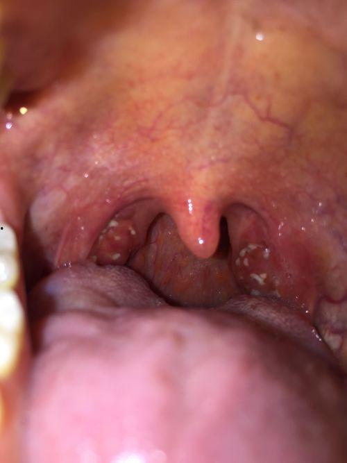 吃瓜后喉咙发涩,原因与缓解方法